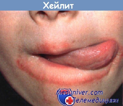 Хейлит - воспаление губ после облизывания