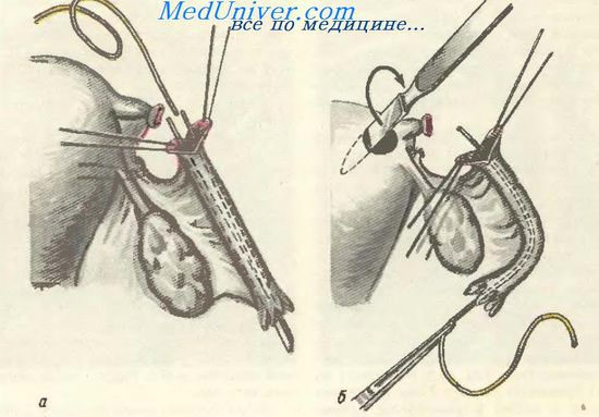 Имплантация проходимой части трубы в матку