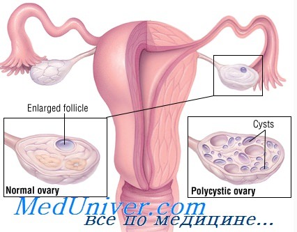 Синдром поликистозных яичников надпочечниковой формы thumbnail