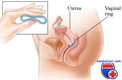 Вагинальное кольцо НоваРинг для контрацепции: принцип действия и нюансы использования
