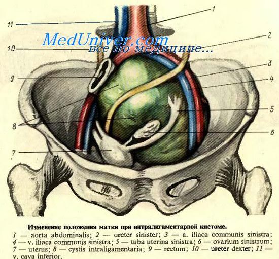 Хирургическая анатомия яичников
