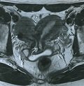 МРТ при двурогой матке