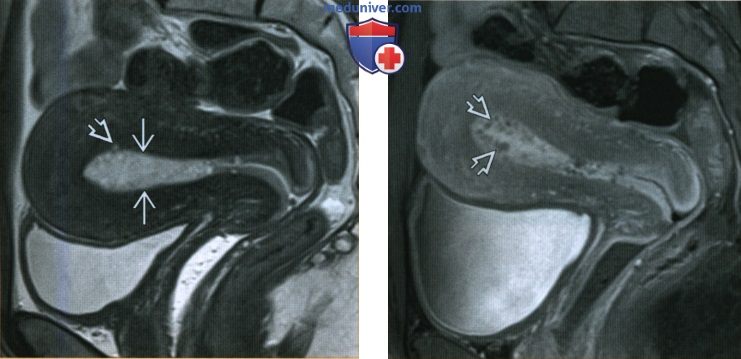 Эхографические признаки гиперплазии предстательной железы на фоне диффузных изменений