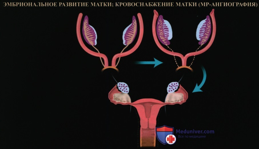КТ, МРТ, УЗИ анатомия матки