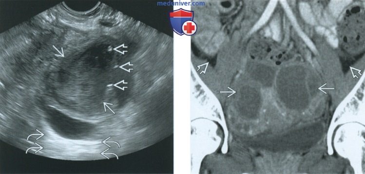 Серозометра матки после 60. Эндометриома яичника на УЗИ. Эндометриома яичников мрт.