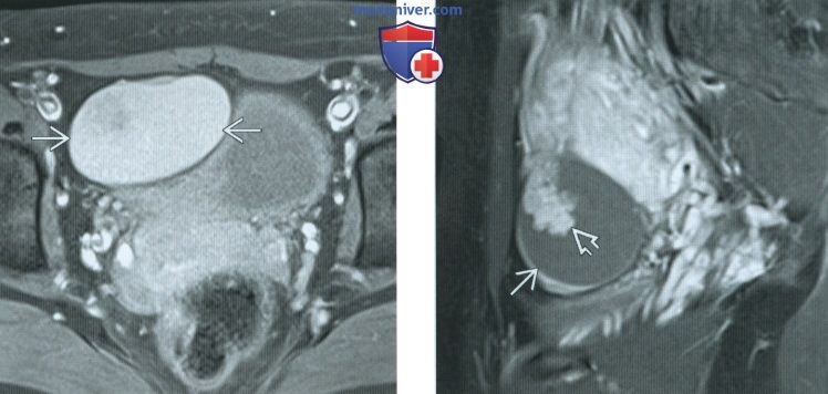 Эндометриоидная киста яичника — симптомы, диагностика и лечение заболевания в Hadassah