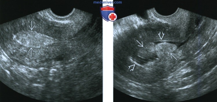 Полип эндометрия (полипы тела матки), причины образования, симптоматика, лечение