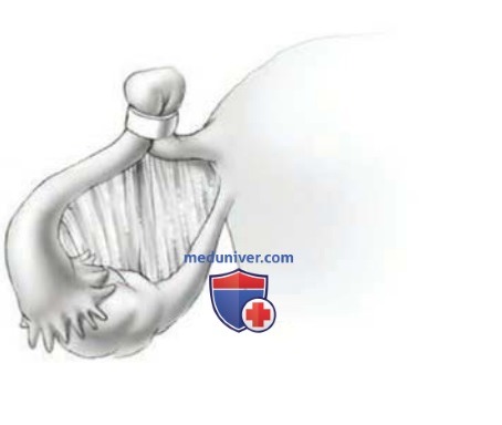 ����������������� ������������ � �������� ���������� ESSURE