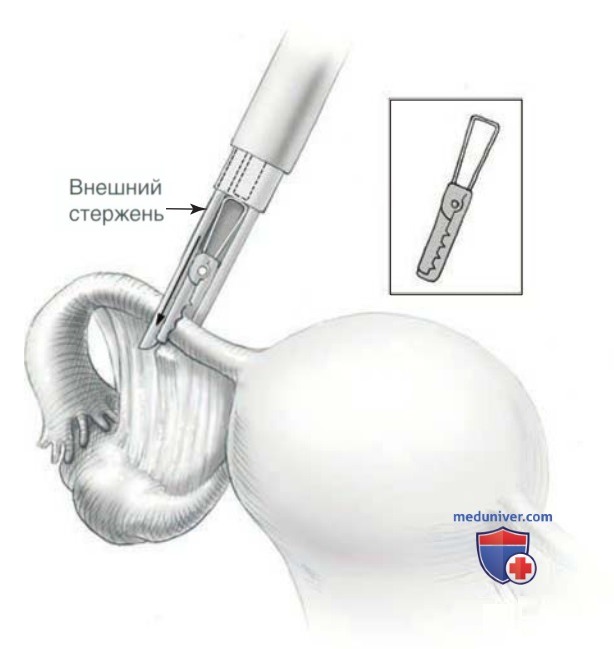 ����������������� ������������ � �������� ���������� ESSURE
