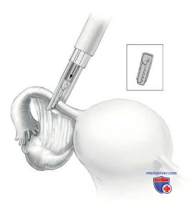 ����������������� ������������ � �������� ���������� ESSURE