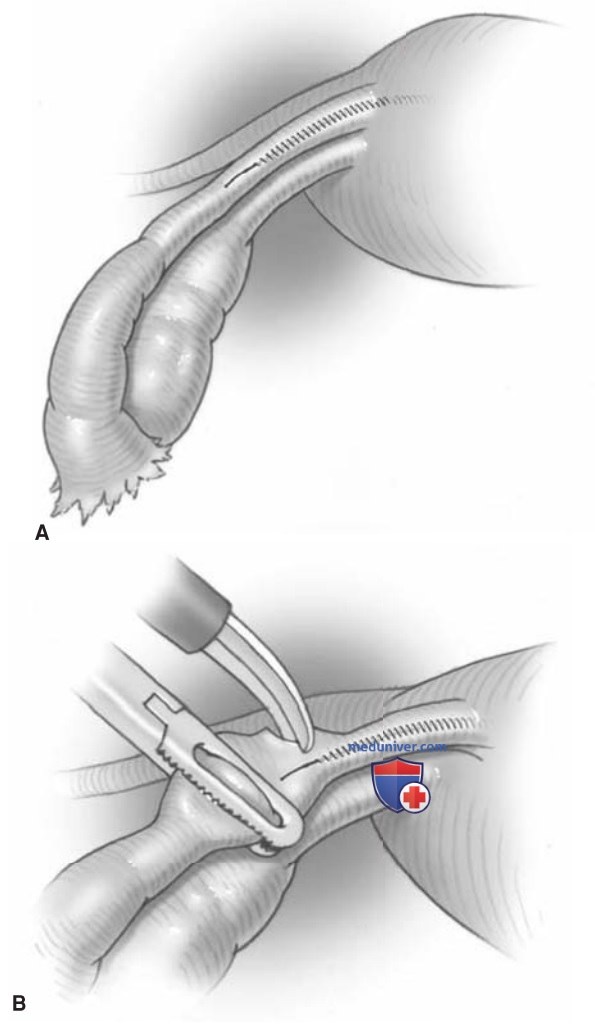 ����������������� ������������ � �������� ���������� ESSURE