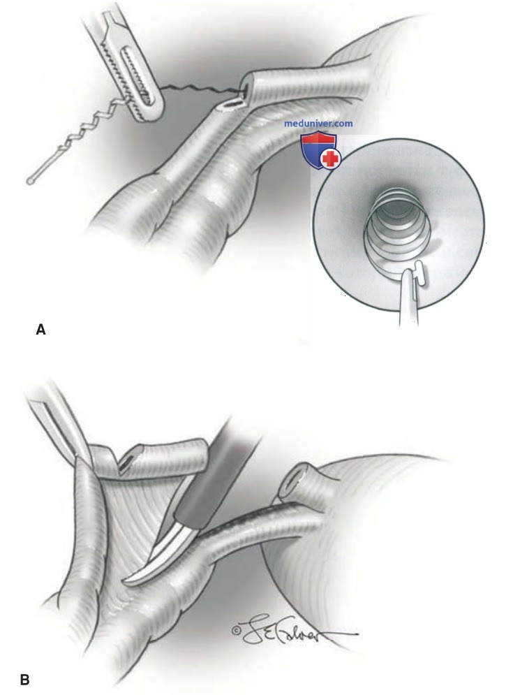 ����������������� ������������ � �������� ���������� ESSURE