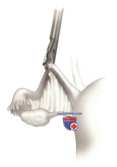 ����������������� ������������ � �������� ���������� ESSURE