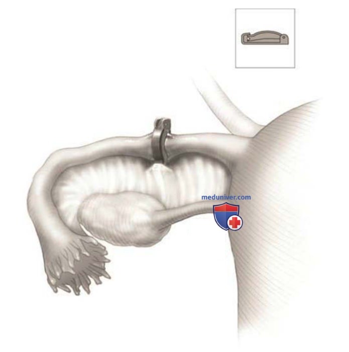 ����������������� ������������ � �������� ���������� ESSURE