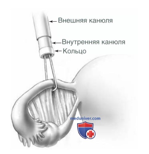 ����������������� ������������ � �������� ���������� ESSURE