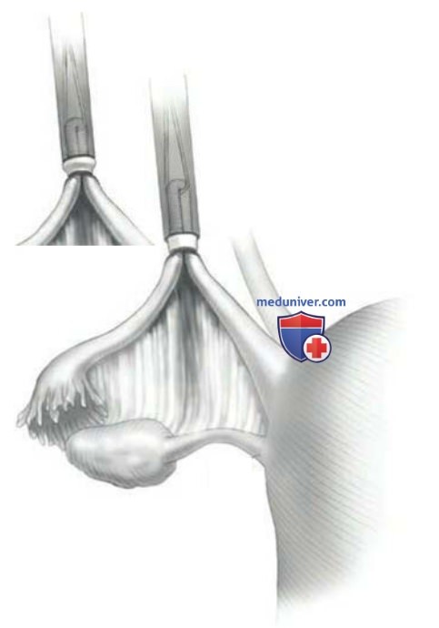 ����������������� ������������ � �������� ���������� ESSURE