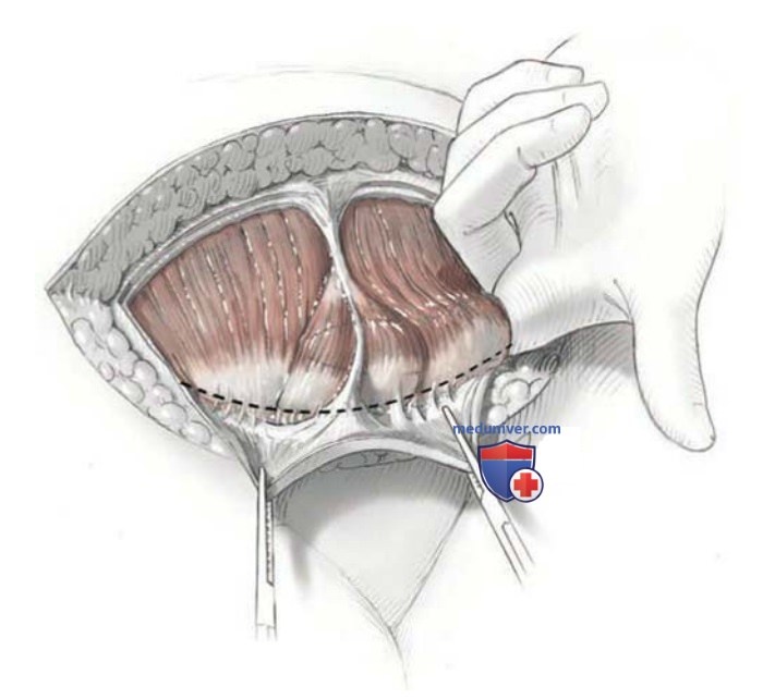 ������ �� ����� (Cherney incision)