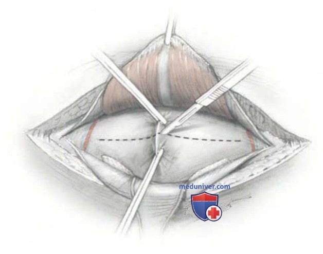 ������ �� ����� (Cherney incision)
