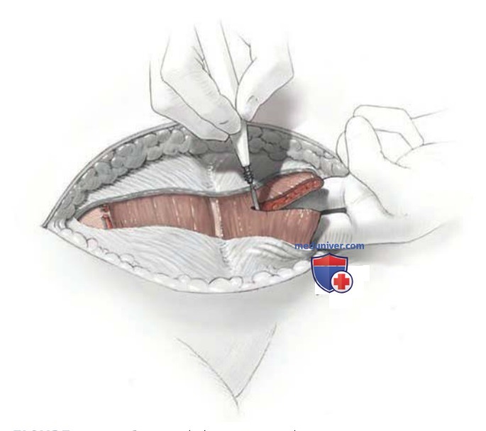 ������ �� �������� (Maylard incision)