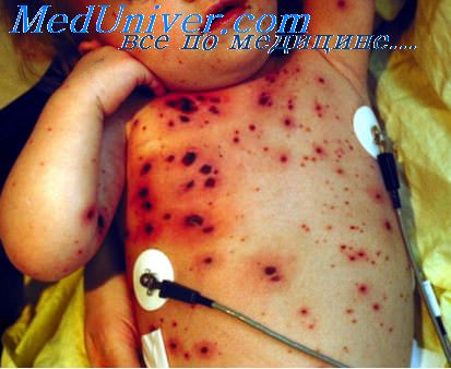 Инфекционные заболевания с геморрагической сыпью thumbnail