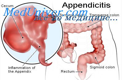 Острая кишечная инфекция дифференциальная диагностика с аппендицитом thumbnail