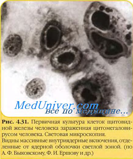 Клиника цитомегаловирусной инфекции. Диагностика цитомегаловируса
