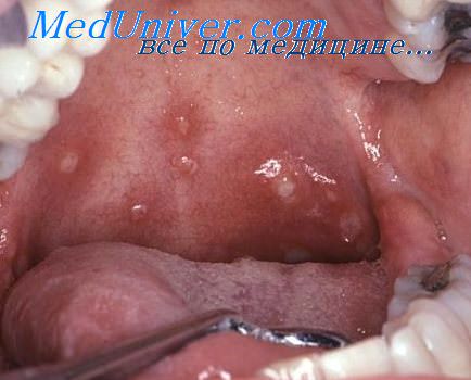 Проявления сифилиса во рту и горле