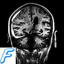Диагностика отека головного мозга. Принципы лечения отека мозга.