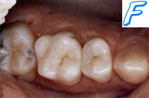 Зубная боль. Боль в зубе. Причины зубной боли. Пульпит. Клиника ( признаки ) пульпита. Неотложная ( первая ) помощь при зубной боли