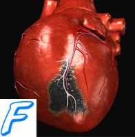 Неотложные состояния при сердечно-сосудистых заболеваниях. Классификация ИБС ( ишемической болезни сердца ).