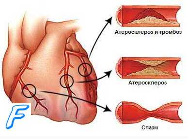 Терапия антикоагулянтами при инфаркте миокарда ( оим, ОИМ ).