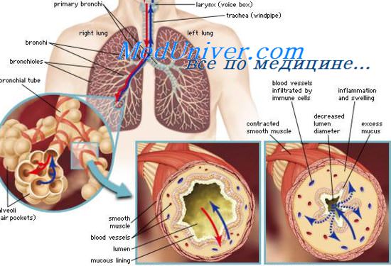 пневмония и астма