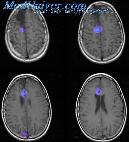 Сколько длится аура при эпилепсии