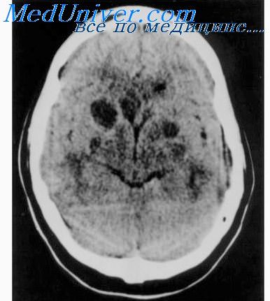 Рентгенография позвоночника в неврологии thumbnail