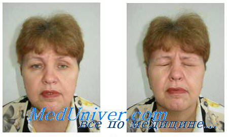 Лечение невропатии лицевого нерва. Методы лечения невропатии лицевого нерва.