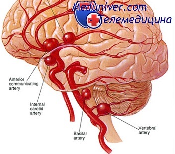 аневризмы сосудов головного мозга