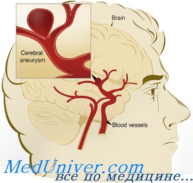эндоваскулярное лечение аневризм мозга