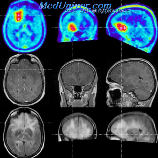 Диагнозы опухоли мозга. Глиальная опухоль головного мозга кт. Глиома головного мозга кт. ПЭТ-кт глиобластома.