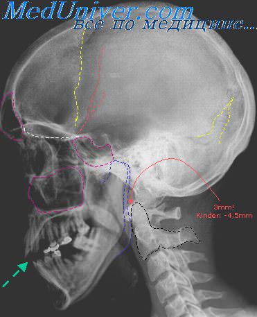 перелом черепа