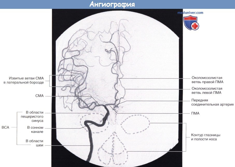 Ангиография головного мозга