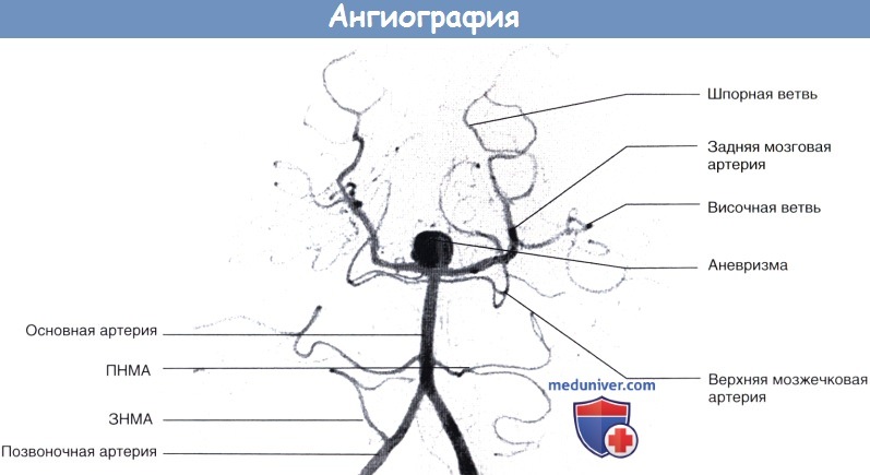 angiografia 6