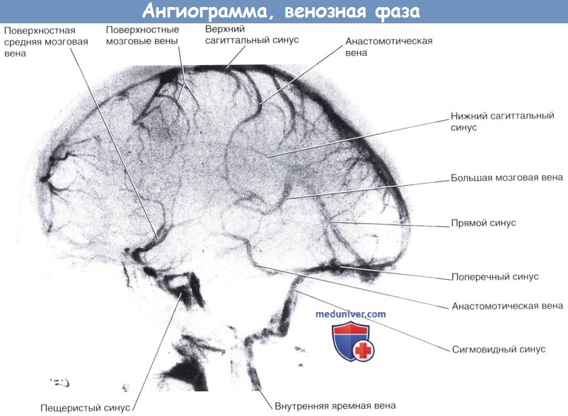 Ангиограмма головного мозга, венозная фаза