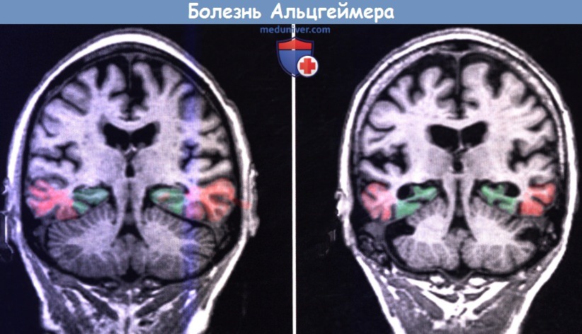 МРТ головного мозга в норме и и при болезни Альцгеймера