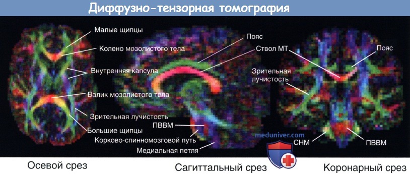 Диффузно-тензорная томография головного мозга