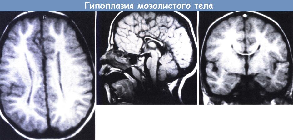 Гипоплазия мозолистого тела