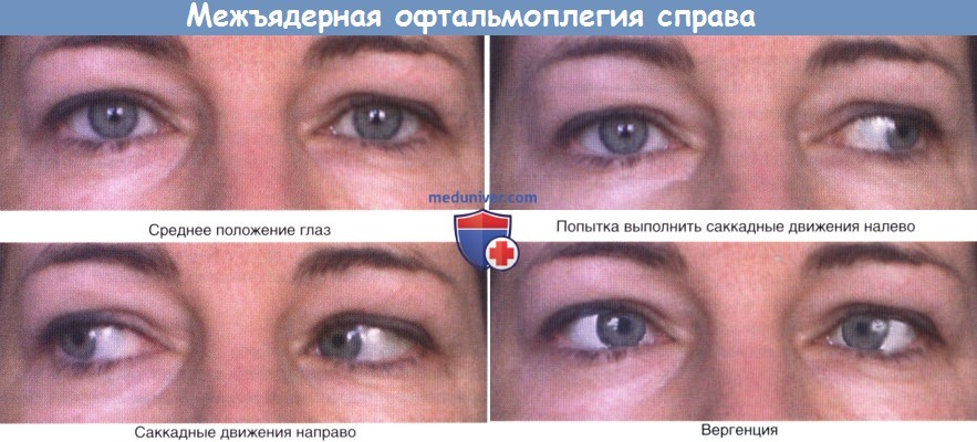 Межъядерная офтальмоплегия справа
