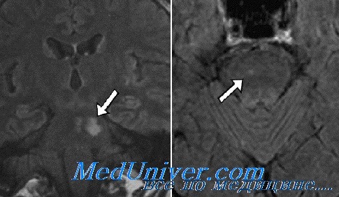 МРТ при головокружении из-за поражения ствола мозга при рассеянном склерозе