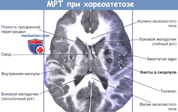 МРТ при хореатетозе
