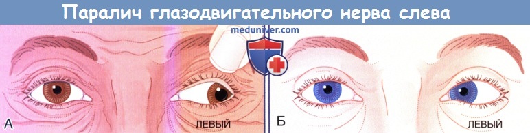 Полный паралич глазодвигательного нерва слева
