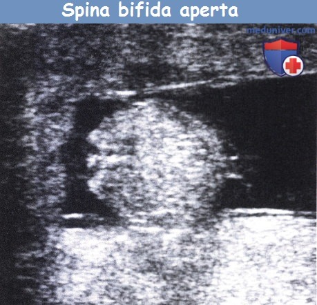 Spina bifida aperta